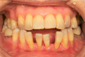 Before