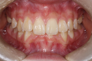 Before
